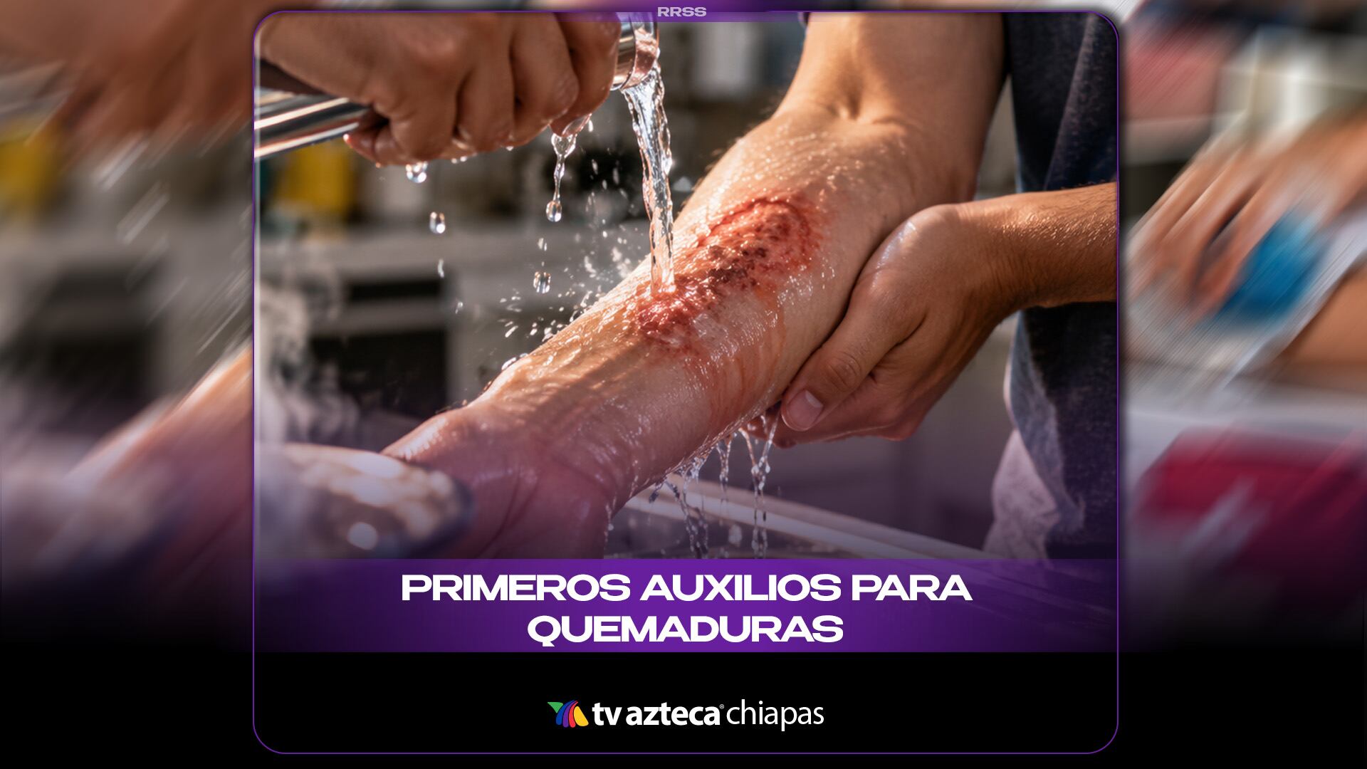 PRIMEROS AUXILIOS PARA QUEMADURAS