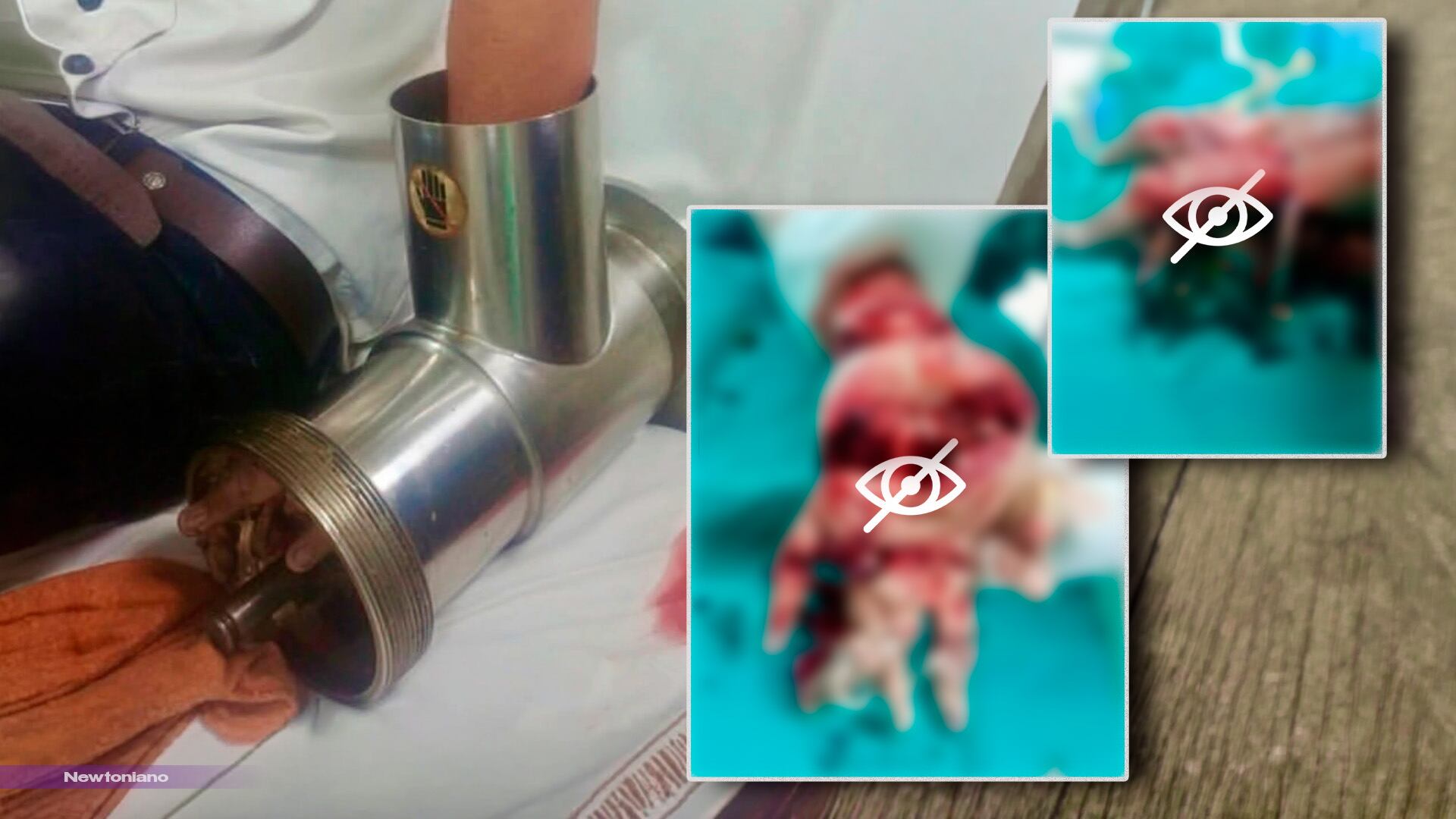 ¡Contenido sensible! Hombre metió la mano en un molino industrial de carne: así llegó al hospital
